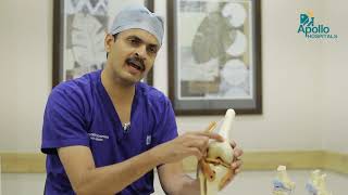 Knee Cap Dislocation Treatment  Dr Pradeep Kocheeppan Orthopedician  Apollo Hospitals Jayanagar [upl. by Cate]