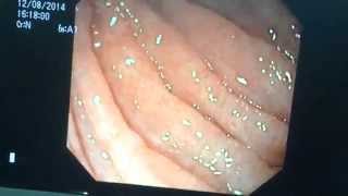 endoscopic biopsy of duodenum [upl. by Khano]