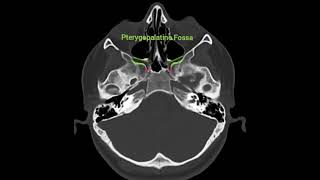 🌺 An anatomical reminder3🌺Foramen Rotundum and Pterygopalatine Fossa🎯Axial CT image [upl. by Garbers]