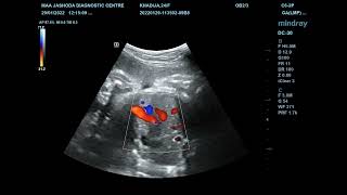 USG DUCTUS VENOSUS DOPPLER AT 34 WKS OF PREGNANCY [upl. by Osnofedli]