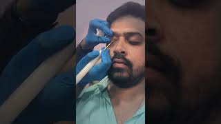 Advanced Xanthelasma Treatment  Kolkata  Skin Care  youtubereels youtubeshorts youtubevideo [upl. by Einaffets]