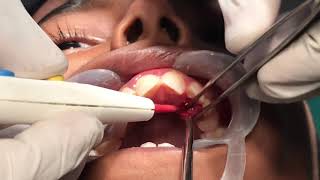 Gingival tumour  hyperplasia of the gums causing bleeding  Excisional Biopsy [upl. by Suiramad411]