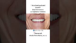 Reabilitare dentară spectaculoasă realizată cu ajutorul a 10 implanturi dentare dentop [upl. by Llehsyt]