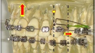 BURSTONE  ARCOS SEGMENTADOS PARA INTRUSÃO COM CONTROLE DE TORQUE [upl. by Ahsieka]