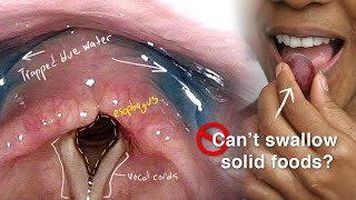 Cricopharyngeal Dysfunction Difficulty Swallowing Especially Solid Foods [upl. by Rettuc844]