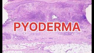 PyodermaType of pyoderma Causes of pyoderma✨ [upl. by Kingsley]