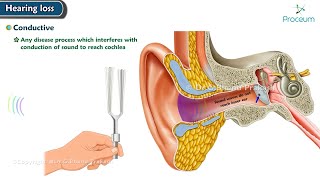 Conductive Hearing loss 🦻🔊 ENT Lecture [upl. by Hahn]