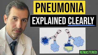 Pneumonia Explained Symptoms Diagnosis Labs Treatment [upl. by Raye]