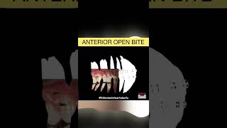 ANTERIOR OPEN BITE  ORTHODONTIC TIPS Shorts [upl. by Iasi]