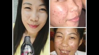 EASY ACNE TREARMENT USING ESKINOL  DALACINC [upl. by Lilias]