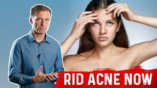 What Causes Acne – The Surprising Hidden Source of Acne – DrBerg [upl. by Aruam]