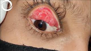 Giant Papillary Conjunctivitis [upl. by Loss319]