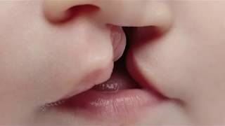 Cleft lip and palate  Akron Childrens Hospital video [upl. by Trilly]