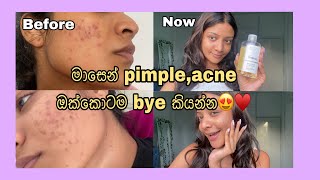 මම Pimples acne නැතිකරගත්තෙ මෙහෙමයි ☺️how I cleared my acne  sapna padukka [upl. by Darbee]