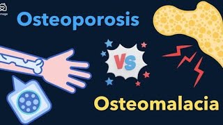 Difference Between Osteoporosis and Osteomalacia [upl. by Prouty160]