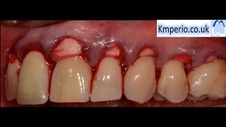 Alloderm Periodontal Surgery for Gum RecessionGraftingRoot CoverageUpper Teeth [upl. by Chelsae944]