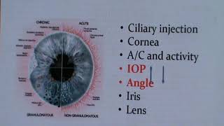 Anterior Uveitis Radwa El Zanaty [upl. by Abrams]