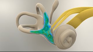 Menieres Disease  What Happens in the Inner Ear [upl. by Ecniuq]