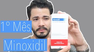 Um Mês usando Minoxidil  Fabio Almeida [upl. by Perce]