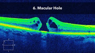 6 Macular Hole MH [upl. by Atirahc750]