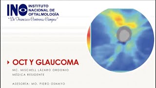 OCT en glaucoma Dra M Lázaro Dr Osnayo Dr Noriega [upl. by Magee]