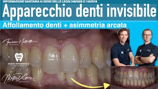 Allineamento dei denti in età adulta [upl. by Asirrom664]