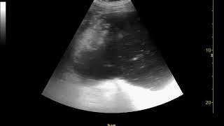 Pointofcare ultrasound of gastric volvulus [upl. by Alegnaed]