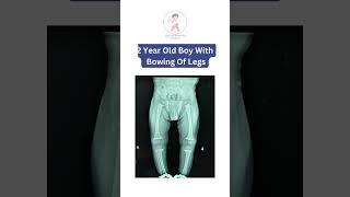 Bowing Of Legs Treated with Vit D by Dr Rajeev Nirawane [upl. by Neffets]