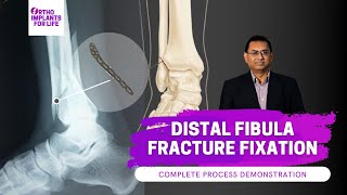 Distal Fibula Fracture and Plate Fixation Procedure [upl. by Reinhardt]