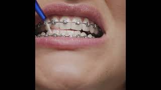 How To Clean Your Tooth After Braces Treatment  All Brite Dentistry [upl. by Ilojne288]