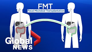 Fecal microbial transplant What is it and how it can it be lifesaving [upl. by Alta552]