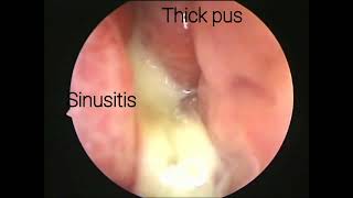 Endoscopic view of the nose showing sinusitis [upl. by Reel]