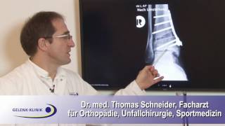 Stellungskorrektur Osteotomie des Sprunggelenks [upl. by Ecilef46]