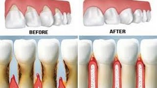 How To Reverse Receding Gum line Without Surgery [upl. by Feinstein]