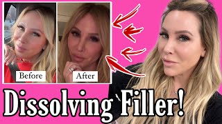 YOUVE BEEN LIED TO ABOUT FILLERS Why I Dissolved My Filler [upl. by Ellata682]