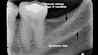 Dental Radiographic Anatomy [upl. by Braynard]