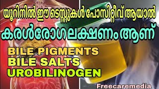 Bilirubin test in urine Bile pigments  Bile salt  Urobilinogen liver disease urine [upl. by Yun]