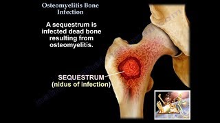 Osteomyelitis Bone Infection  Everything You Need To Know  Dr Nabil Ebraheim [upl. by Ojok]