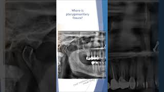 OPG LANDMARKS series Pterygomaxillary fissure oral radiology dental opg [upl. by Franklin]