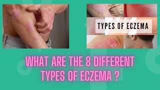 What Are the 8 Different Types of Eczema eczema [upl. by Yeldar]