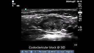 costoclavicular block  27 August 24 [upl. by Aerdied]