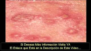 Como Eliminar Herpes Remedios Naturales Cure Su Herpes [upl. by Llevel]