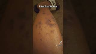 LICHEN PLANUS ECZEMA PSORIASIS ACNE CAST DAMAGE BURNS [upl. by Jarita]