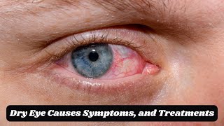 Managing Severe Dry Eye Cases Causes Symptoms and Treatments [upl. by Ecire]