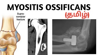 Myositis ossificans  causes  symptoms  treatment தமிழ் [upl. by Layor153]