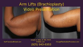 Brachioplasty SF Bay Area Arm Lifts and Arm Skin Tightening  10 [upl. by Ahsel]