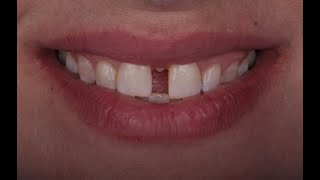 A combined approach for diastema closure [upl. by Gibb]