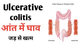 Ulcerative colitis  Traetment and Symptoms  Colistis ko theek kaise kare [upl. by Crary]