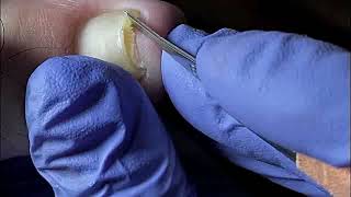 DIY Ingrown Toenail Removal  How to Safely Cut Ingrown Toenails at Home [upl. by Leahcir101]