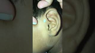 Squeezing preauricular pit earpit satisfying pimplepopping [upl. by Ethbinium335]